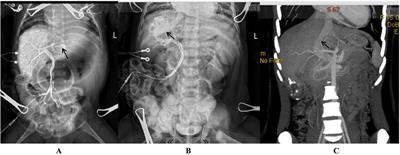 Congenital intrahepatic portosystemic shunt in 27 children: an experience and treatment strategy of a single centre in China